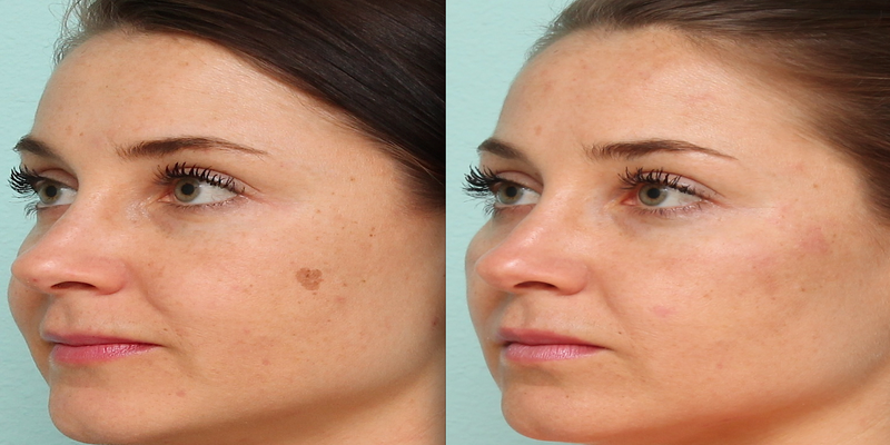 Age Spots, Can Be Eliminated